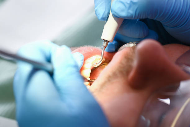 Best Emergency Dentist for Knocked-Out Tooth in Crisfield, MD